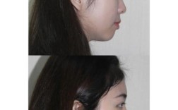 矫正牙齿前后侧面变化有多大？