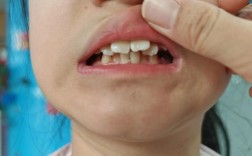 矫正牙齿时没拔智齿，会影响矫正效果吗？