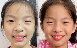 牙齿稀疏矫正前后效果