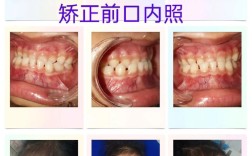 儿童反咬合（地包天）矫正有哪些常用方法？最佳干预年龄是几岁？如何选择适合的矫正方式？