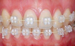 正畸陶瓷托槽碎了一块