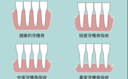 正畸牙根吸收的研究