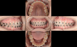 拔牙矫正收缝隙，过程要多久？怎么收才有效？