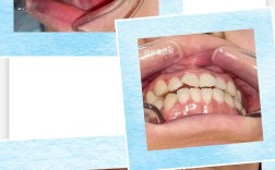 牙齿扭转的治疗方法有哪些具体方案？