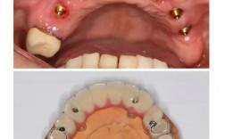 半口种植牙最少需要种几颗？这个数量有最低标准吗？