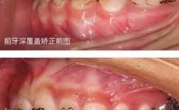 磨牙深覆盖正畸方法