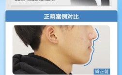 男生牙齿正畸案例效果如何？矫正过程复杂吗？