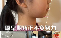 儿童偏颌矫正方法有哪些？如何科学选择？