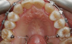 正畸各种弓弯制