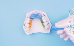 活动矫治器妃她正畸