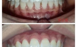 修复好还是正畸好