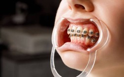 30岁矫正牙齿还来得及吗？年龄会影响效果吗？