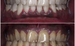 正畸后牙齿色素沉积，原因是什么？如何清除？