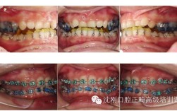 沈刚正畸分类视频