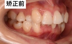 正畸扩后牙间隙