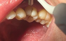 牙体充填术补牙方法