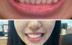 隐形正畸的效果究竟怎么样？美观度、舒适度、矫正效果和周期真的能兼顾吗？