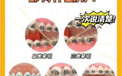 阻生齿能通过正畸牵引矫正吗？