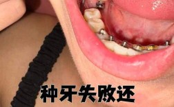 种牙失败后，身体和口腔会出现哪些问题？