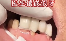 镶牙后为何需重新种牙？是镶牙失败还是另有原因？