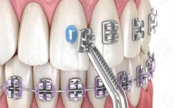 鄂尔多斯矫正牙齿效果怎么样？