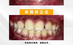 牙齿矫正美学矫正