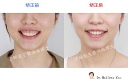 24岁矫正牙齿还来得及吗？成年人矫正会不会太晚？