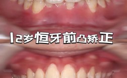 矫正牙齿中线偏移？是什么原因导致的又该如何有效矫正？