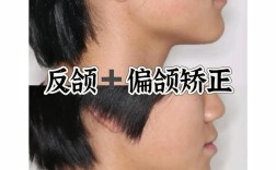 矫正牙齿会导致颧骨变宽吗？