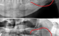 低位水平阻生齿正畸