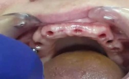 种牙无菌没做好