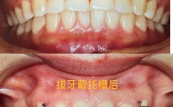 月经期能拔正畸牙吗？有哪些注意事项？