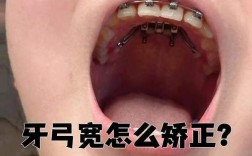 牙弓窄做不了正畸