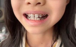 上海松江区矫正牙齿，哪家医院靠谱？效果如何？价格多少？