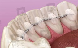 固定松动牙齿，哪种方法最有效可靠？
