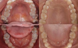 水平阻生智齿前移正畸