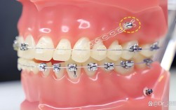 牙齿矫正打骨钉图片能看清哪些关键矫正细节？