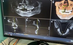 计算机导航植牙相比传统植牙，精准度和安全性优势何在？