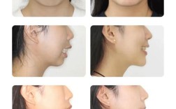 正畸四个月想正颌