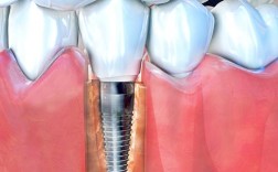 牙槽骨不够宽种牙