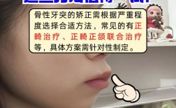 牙齿骨性前凸怎么矫正？有哪些有效方法？