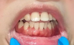 牙周炎没治好就勉强种牙，会有什么后果？