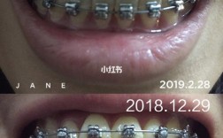 矫正牙齿钢丝变化