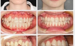 深圳牙齿矫正哪家最好？如何选到靠谱又专业的机构？