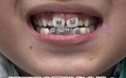 牙齿单侧正畸补缺齿