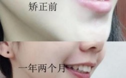 兔子牙矫正有哪些方法？效果能维持多久？