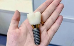 12000种植牙包含哪些项目？性价比如何？