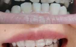 矫正牙齿后为何留缝隙？原因与处理方法