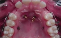 埋伏牙牵引后正畸护理有哪些关键要点需注意？