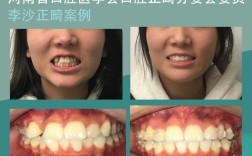 牙齿矫正必须签协议吗？